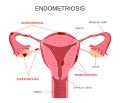 اندومتریوز(Endometriosis)